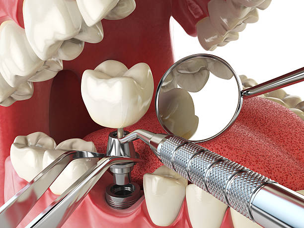 Best Emergency Dental Extractions in Mount Hope, NJ